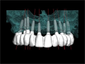 Implant tbr z1 et mci 001 riqe1r - Eugenol