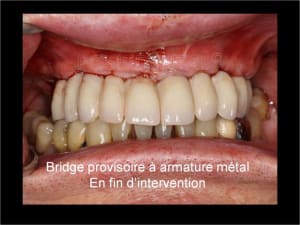 Implant tbr z1 et mci 003 ck7rrm - Eugenol