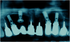 Implants q5f02j - Eugenol