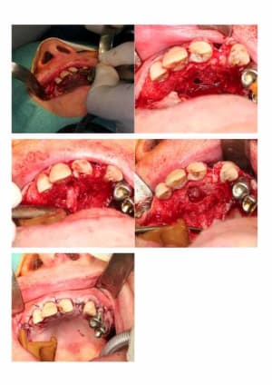 Kyste suite et fin hqgulf - Eugenol