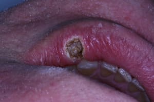Laser levre inf gauche 005 whikyv - Eugenol