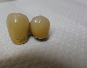 Métal visible sur ccm terminée zihfv3 - Eugenol