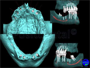 Mcipe bi maxillaire du 13 f vier 2012 005 mxmlpv - Eugenol