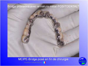 Mci  mise en charge imm diate  chirurgie implantaire guid e 002 srwwix - Eugenol