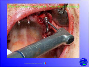 Mci  mise en charge imm diate  chirurgie implantaire guid e 010 kdrptt - Eugenol
