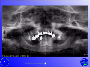 Mise en chage imm diate 001 dlce48 - Eugenol
