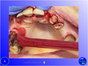 Mise en chage imm diate 004 icwbil - Eugenol