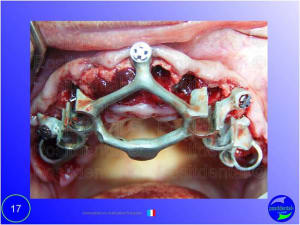 Mise en chage imm diate 017 f2sd5d - Eugenol