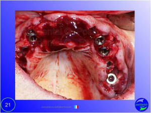 Mise en chage imm diate 021 tgupmu - Eugenol