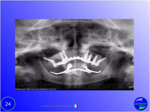 Mise en chage imm diate 024 ynjcsq - Eugenol