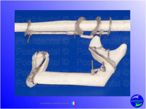 Mise en chage imm diate 039 f4oiec - Eugenol