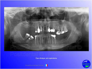 Mise en chage imm diate 053 zotabp - Eugenol