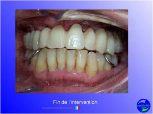 Mise en chage imm diate 098 vympnt - Eugenol