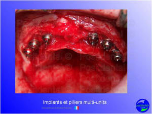 Mise en chage imm diate 101 l6kn5q - Eugenol