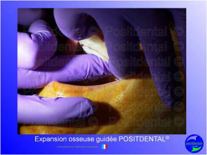 Mise en chage imm diate 129 kjgwet - Eugenol