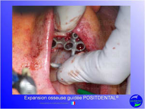Mise en chage imm diate 135 yb1zc5 - Eugenol