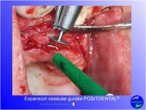 Mise en chage imm diate 140 oy6sl1 - Eugenol