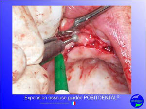 Mise en chage imm diate 148 zzz8vm - Eugenol