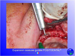 Mise en chage imm diate 149 h2wf62 - Eugenol