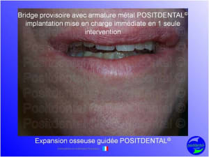 Mise en chage imm diate 164 bkedzl - Eugenol