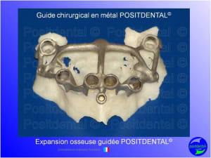 Mise en chage imm diate 165 fvaqs8 - Eugenol