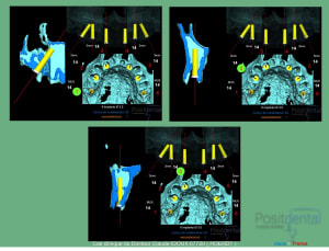 Mise en charge immédiade c - Eugenol