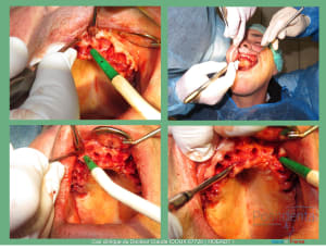 Mise en charge immédiade c - Eugenol