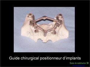 Mise en charge immédiate implant dentaire 015 w08fro - Eugenol