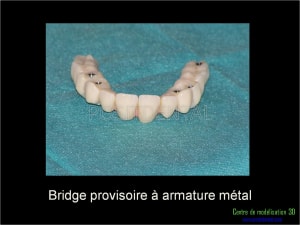 Mise en charge immédiate implant dentaire 016 lq7bj4 - Eugenol