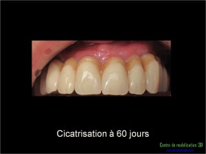 Mise en charge immédiate implant dentaire 022 zupm8b - Eugenol