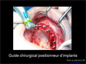 Mise en charge immédiate implant dentaire 044 lq8iz0 - Eugenol