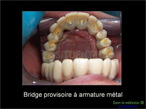 Mise en charge immédiate implant dentaire 048 staeu9 - Eugenol