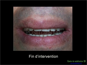 Mise en charge immédiate implant dentaire 049 rubtjs - Eugenol