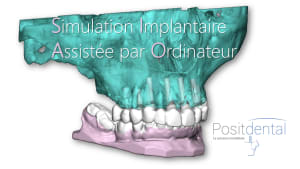 Mise en charge innédiate positdental 005 t29gon - Eugenol