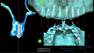 Mise en charge innédiate positdental 012 jkbskv - Eugenol
