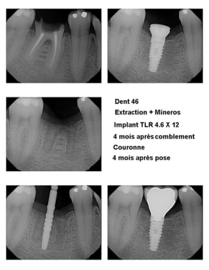 Montage  implant 46 b1vowc - Eugenol