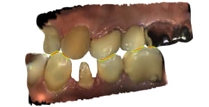 Occlusion 1 id85 brnyjf - Eugenol