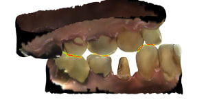 Occlusion 2 id85 fqgalp - Eugenol