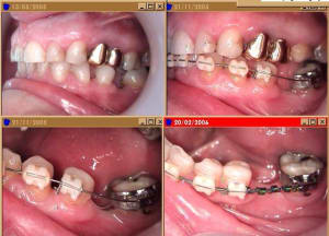 Odf pre implant mrirgk - Eugenol