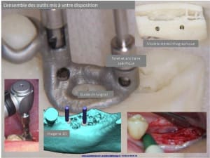 Positdental guide chirurgical kt3jny - Eugenol