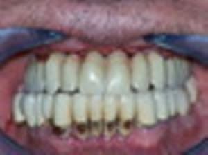 Positdental 150528 070 thumb zthiqa - Eugenol