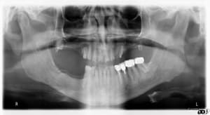 Pre op hsibih - Eugenol