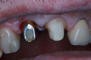 Pr  op couronnes 11 21 007 z4iohb - Eugenol