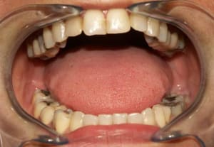 Patiente 2 hgh1cw - Eugenol