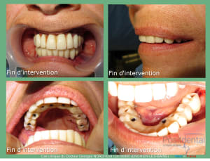 Pose d implants et d un bridge à armature métal en 1 seule intervention g - Eugenol
