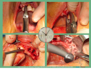 Pose d implants et d un bridge à armature métal en 1 seule intervention g - Eugenol