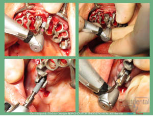 Pose d implants et d un bridge à armature métal en 1 seule intervention g - Eugenol