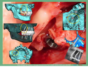 Pose d implants et d un bridge à armature métal en 1 seule intervention g - Eugenol
