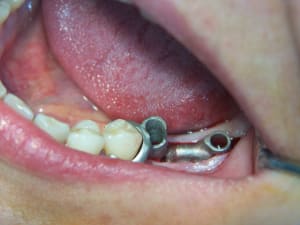 Positdental 015 qvhxmc - Eugenol