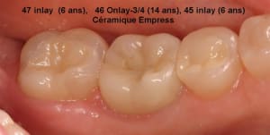 Q4 post op tlogba - Eugenol